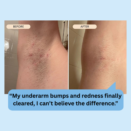 Razor Bumps & Ingrown Hair Serum