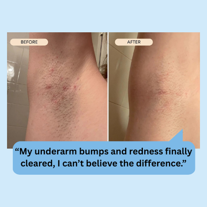 Razor Bumps & Ingrown Hair Serum